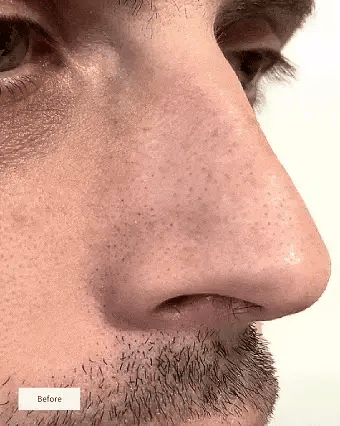 Clinclii™ Hydrocolloid Nose Patches